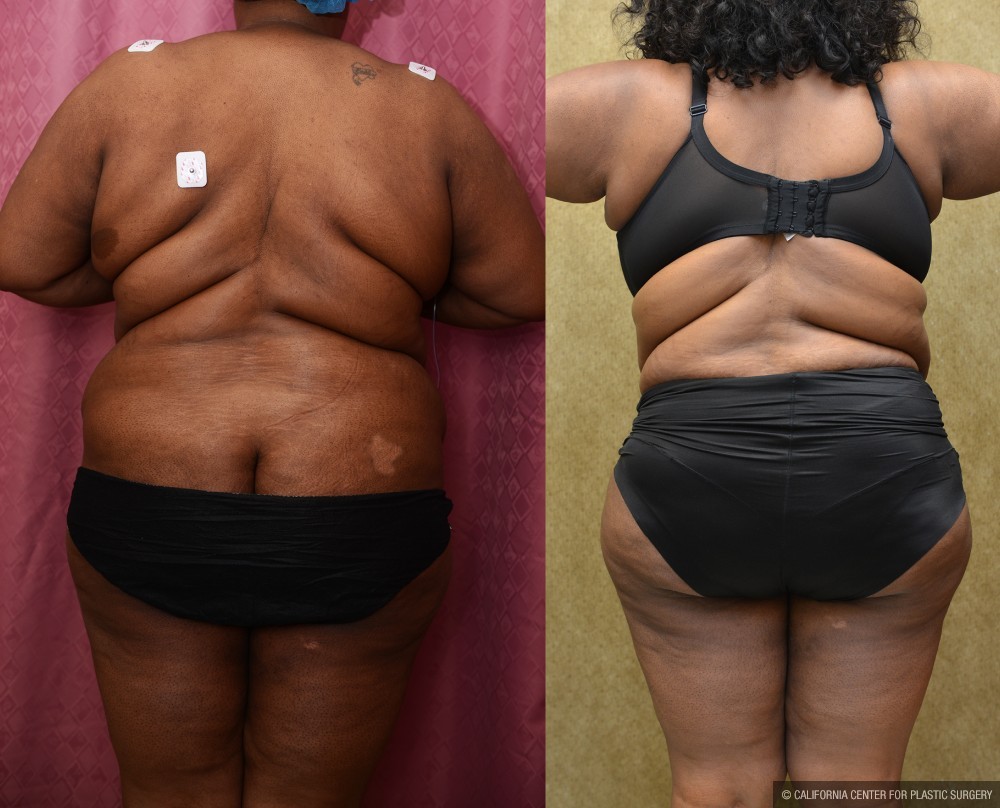 African American Tummy Tuck (Abdominoplasty) Before & After Patient #13434