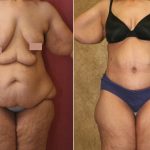 Tummy Tuck (Abdominoplasty) Super Plus Size Before & After Patient #13612