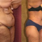 Tummy Tuck (Abdominoplasty) Super Plus Size Before & After Patient #13612