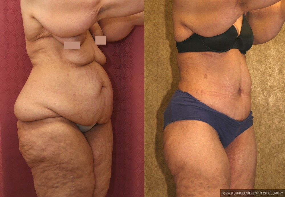 Tummy Tuck (Abdominoplasty) Super Plus Size Before & After Patient #13612