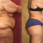 Tummy Tuck (Abdominoplasty) Super Plus Size Before & After Patient #13612