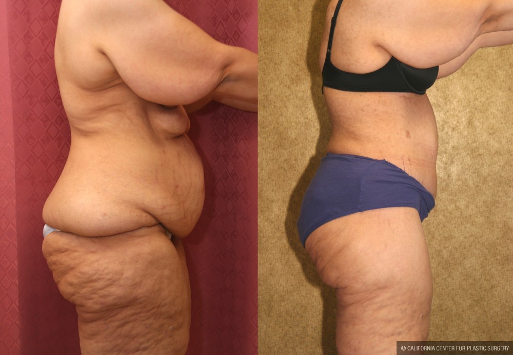 Tummy Tuck (Abdominoplasty) Super Plus Size Before & After Patient #13612