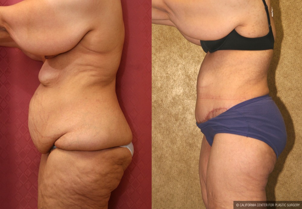 Tummy Tuck (Abdominoplasty) Super Plus Size Before & After Patient #13612