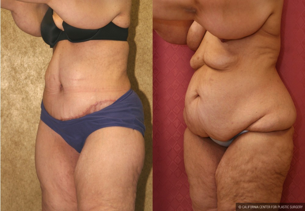 Tummy Tuck (Abdominoplasty) Super Plus Size Before & After Patient #13612