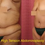 Tummy Tuck (Abdominoplasty) Super Plus Size Before & After Patient #13642