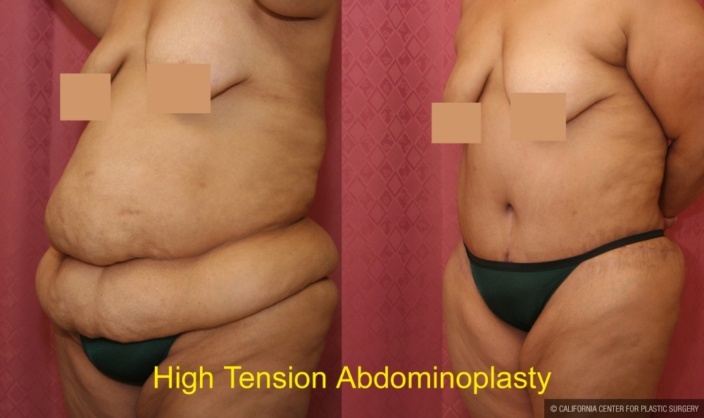 Tummy Tuck (Abdominoplasty) Super Plus Size Before & After Patient #13642