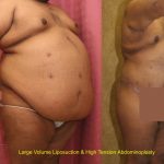 Tummy Tuck (Abdominoplasty) Super Plus Size Before & After Patient #13607