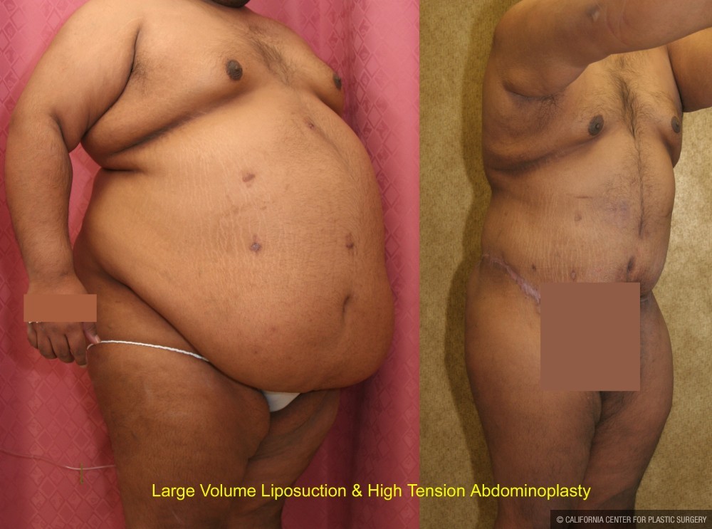 Tummy Tuck (Abdominoplasty) Super Plus Size Before & After Patient #13607