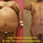 Tummy Tuck (Abdominoplasty) Super Plus Size Before & After Patient #13607