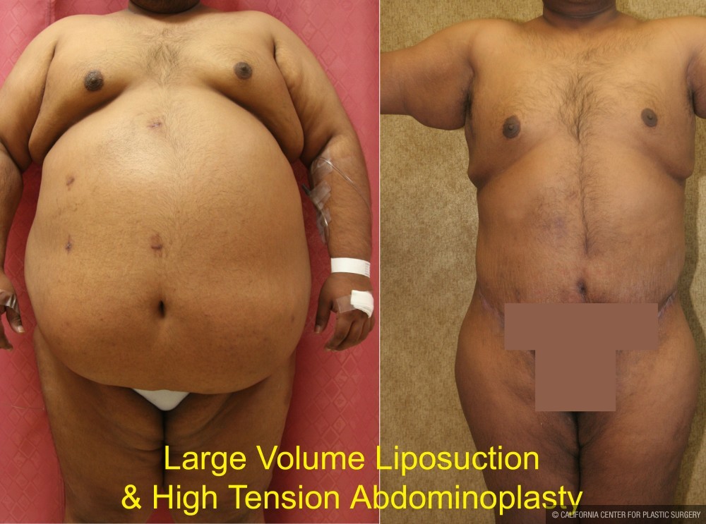 Tummy Tuck (Abdominoplasty) Super Plus Size Before & After Patient #13607