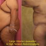 Tummy Tuck (Abdominoplasty) Super Plus Size Before & After Patient #13607