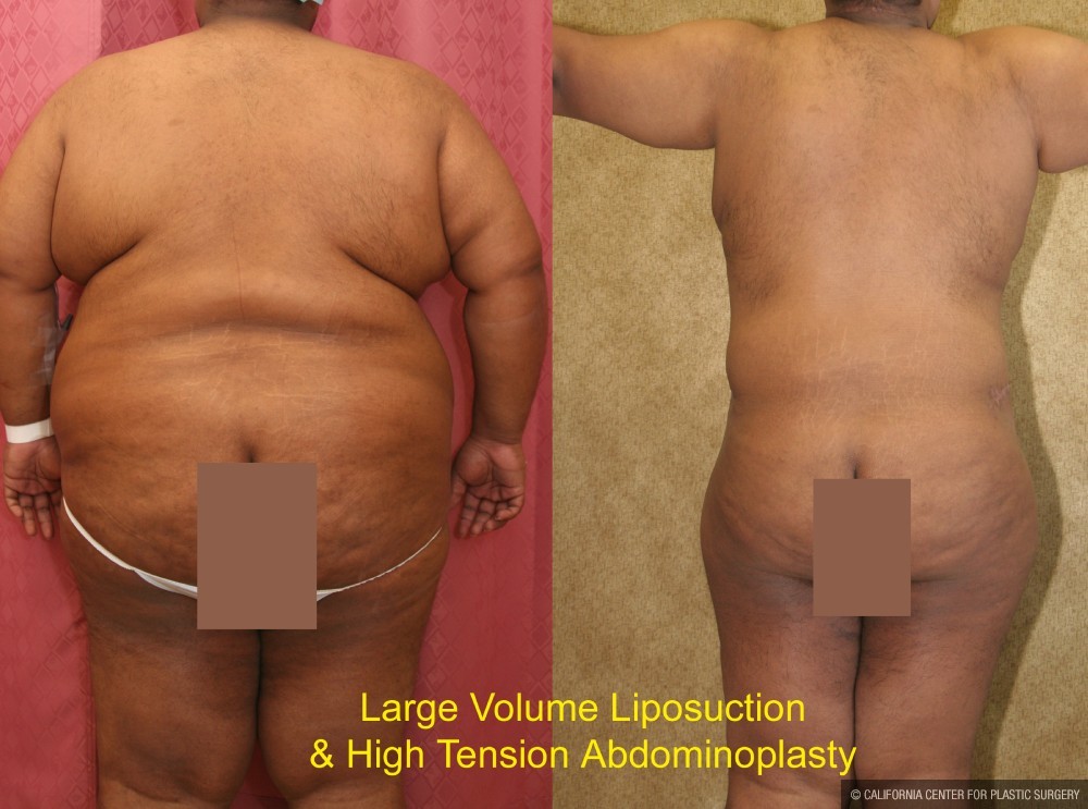 Tummy Tuck (Abdominoplasty) Super Plus Size Before & After Patient #13607