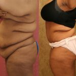 Tummy Tuck (Abdominoplasty) Super Plus Size Before & After Patient #13637