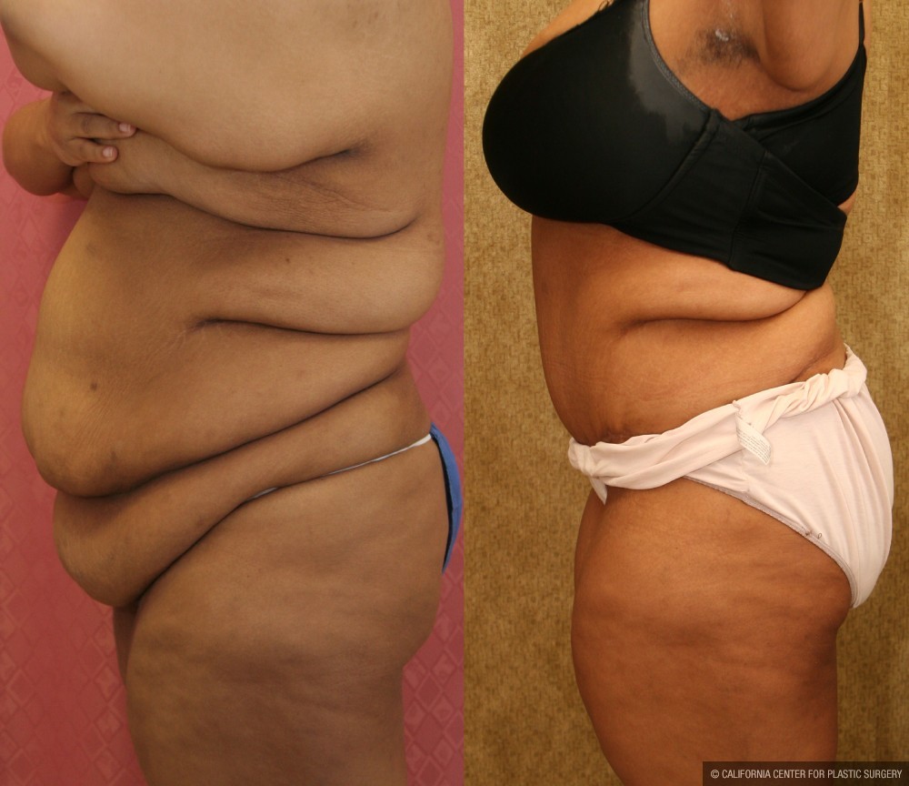 Tummy Tuck (Abdominoplasty) Super Plus Size Before & After Patient #13637