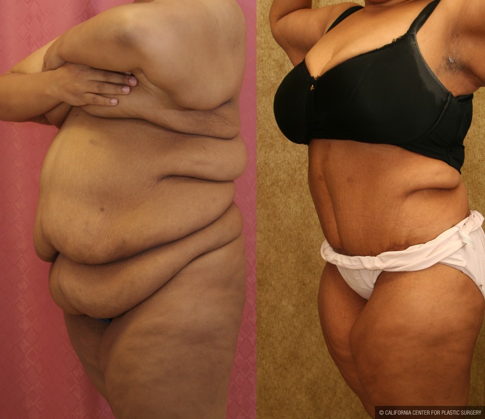 Tummy Tuck (Abdominoplasty) Super Plus Size Before & After Patient #13637