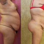 Liposuction Abdomen Plus Size Before & After Patient #13543