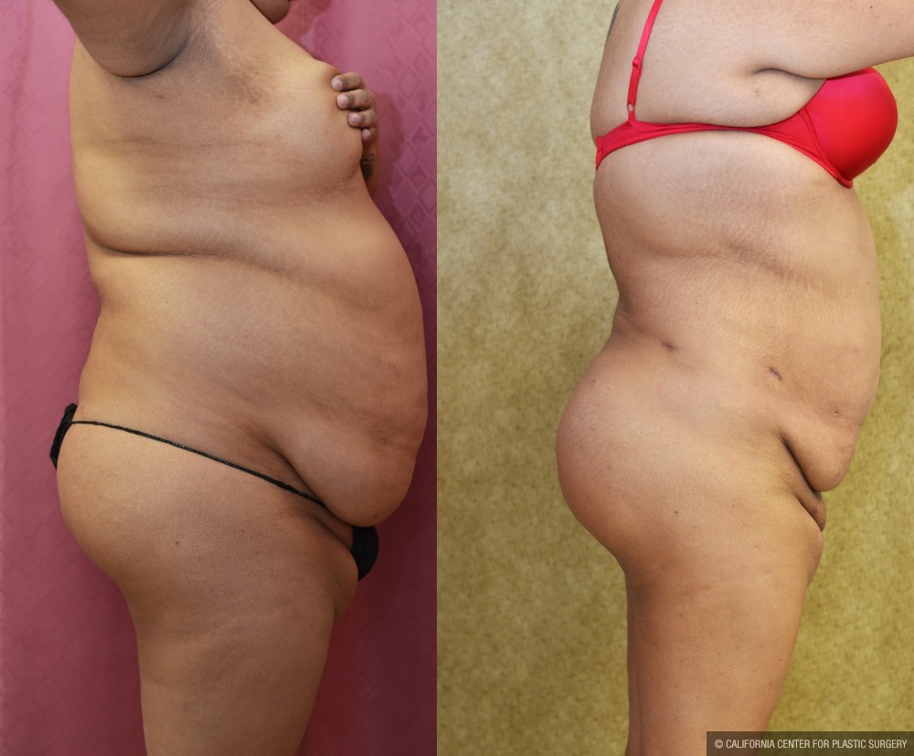 Liposuction Abdomen Plus Size Before & After Patient #13543