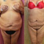 Liposuction Abdomen Plus Size Before & After Patient #13543