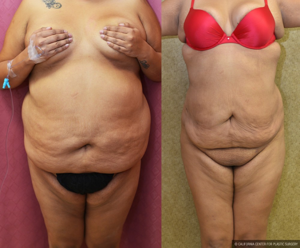 Liposuction Abdomen Plus Size Before & After Patient #13543