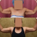 Arm Lift (Brachioplasty) Before & After Patient #13670
