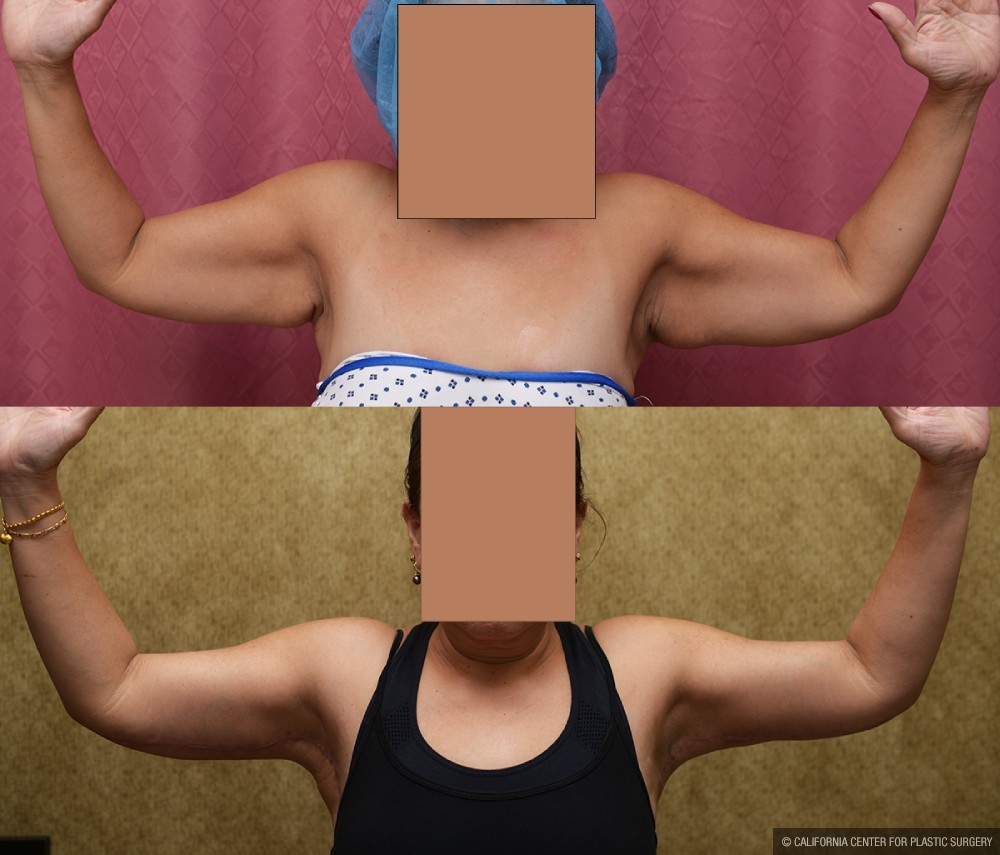 Arm Lift (Brachioplasty) Before & After Patient #13670