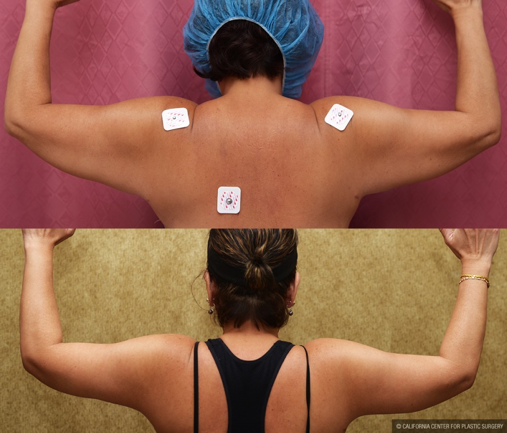 Arm Lift (Brachioplasty) Before & After Patient #13670