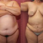 Tummy Tuck (Abdominoplasty) Super Plus Size Before & After Patient #13618