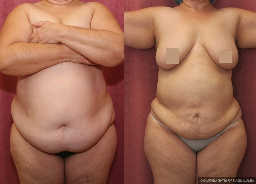 Tummy Tuck (Abdominoplasty) Super Plus Size Before & After Patient #13618