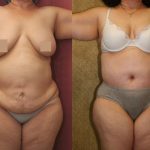 Tummy Tuck (Abdominoplasty) Super Plus Size Before & After Patient #13618