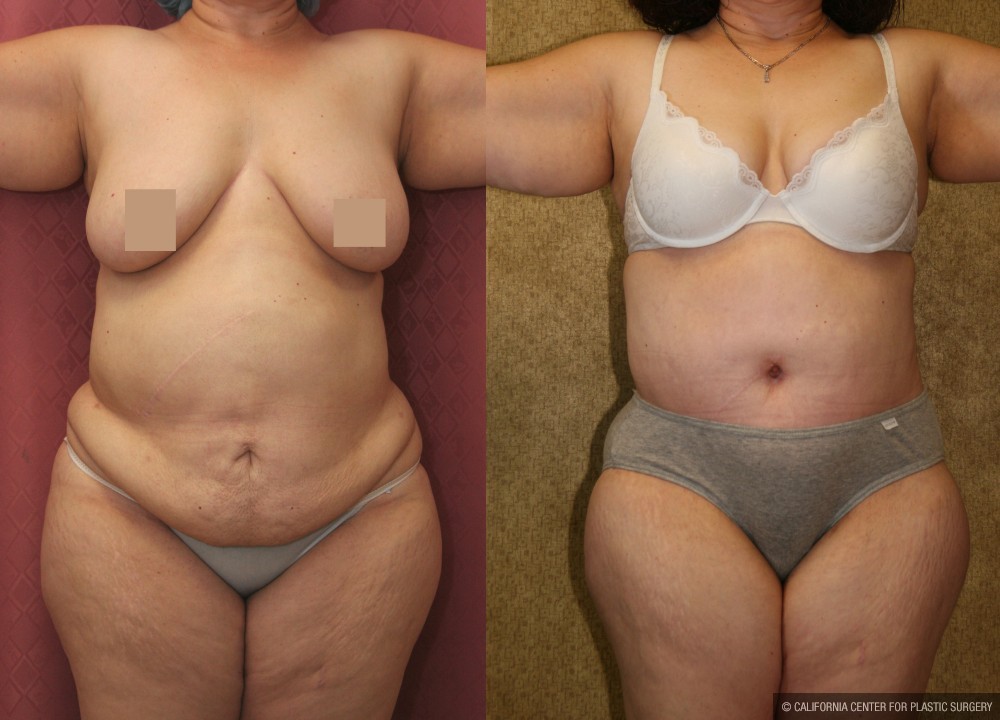 Tummy Tuck (Abdominoplasty) Super Plus Size Before & After Patient #13618