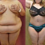 Tummy Tuck (Abdominoplasty) Super Plus Size Before & After Patient #13646