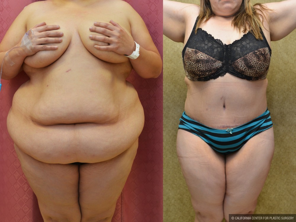 Tummy Tuck (Abdominoplasty) Super Plus Size Before & After Patient #13646