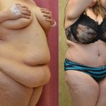 Tummy Tuck (Abdominoplasty) Super Plus Size Before & After Patient #13646