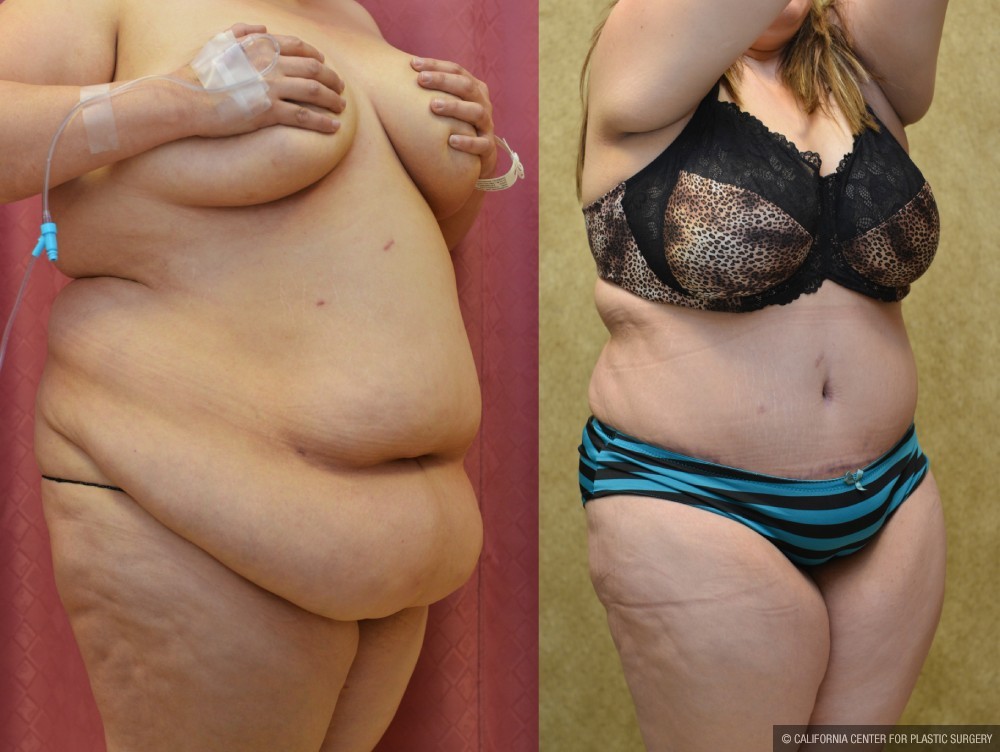 Tummy Tuck (Abdominoplasty) Super Plus Size Before & After Patient #13646