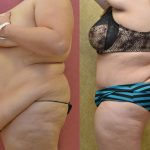 Tummy Tuck (Abdominoplasty) Super Plus Size Before & After Patient #13646