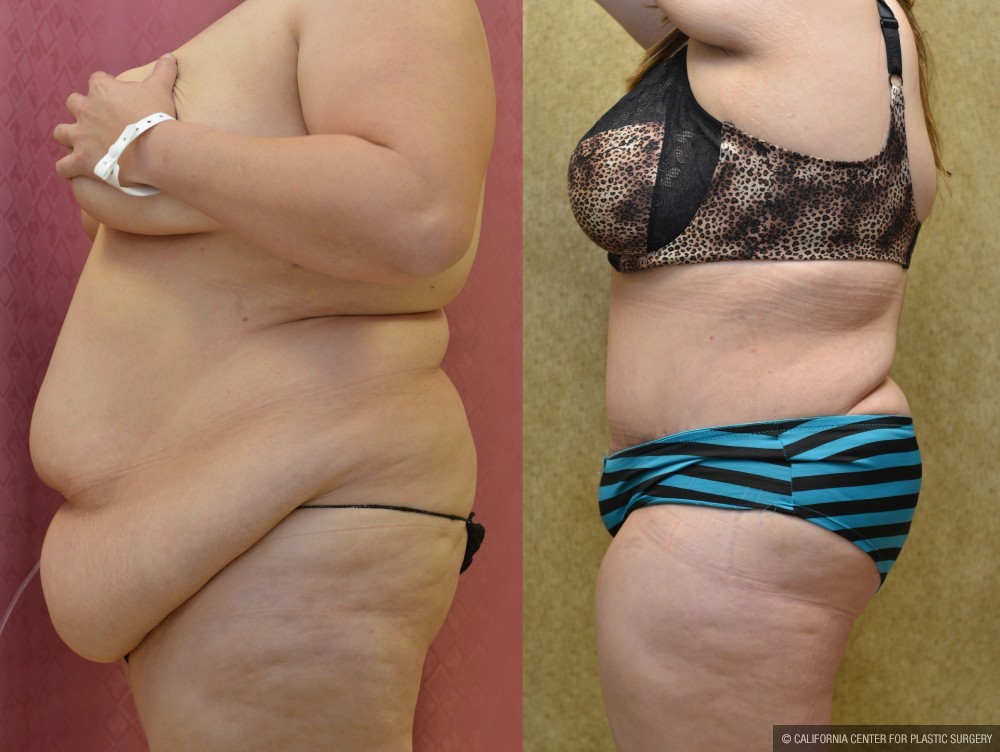 Tummy Tuck (Abdominoplasty) Super Plus Size Before & After Patient #13646