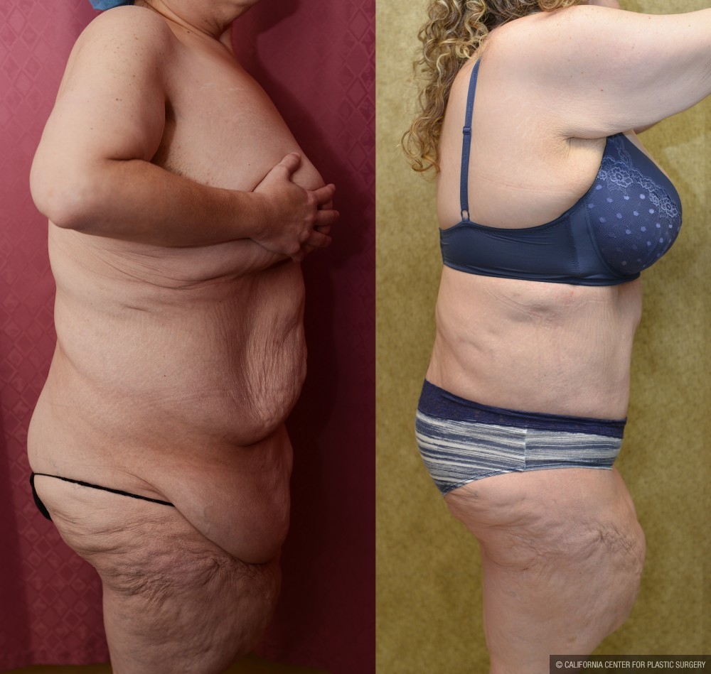Tummy Tuck (Abdominoplasty) Super Plus Size Before & After Patient #13629