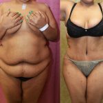 Tummy Tuck (Abdominoplasty) Super Plus Size Before & After Patient #13650