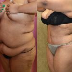 Tummy Tuck (Abdominoplasty) Super Plus Size Before & After Patient #13650