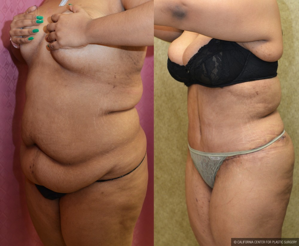 Tummy Tuck (Abdominoplasty) Super Plus Size Before & After Patient #13650