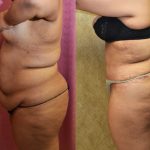 Tummy Tuck (Abdominoplasty) Super Plus Size Before & After Patient #13650