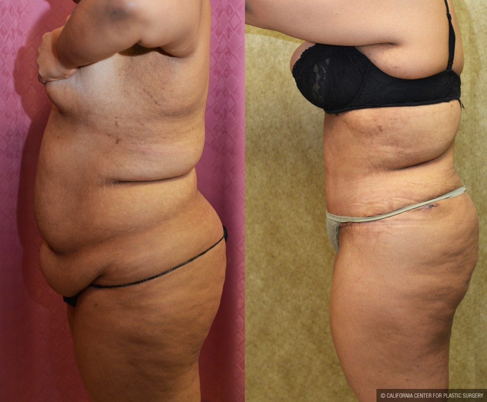 Tummy Tuck (Abdominoplasty) Super Plus Size Before & After Patient #13650