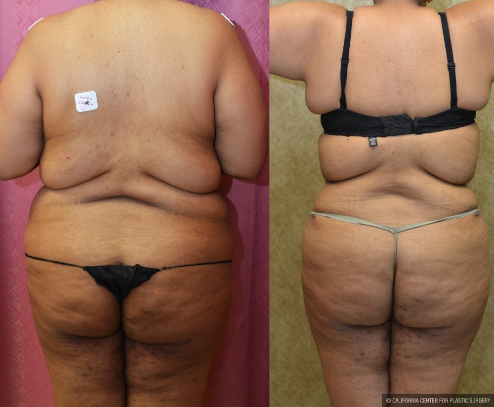 Tummy Tuck (Abdominoplasty) Super Plus Size Before & After Patient #13650