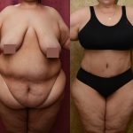 Tummy Tuck (Abdominoplasty) Super Plus Size Before & After Patient #13655