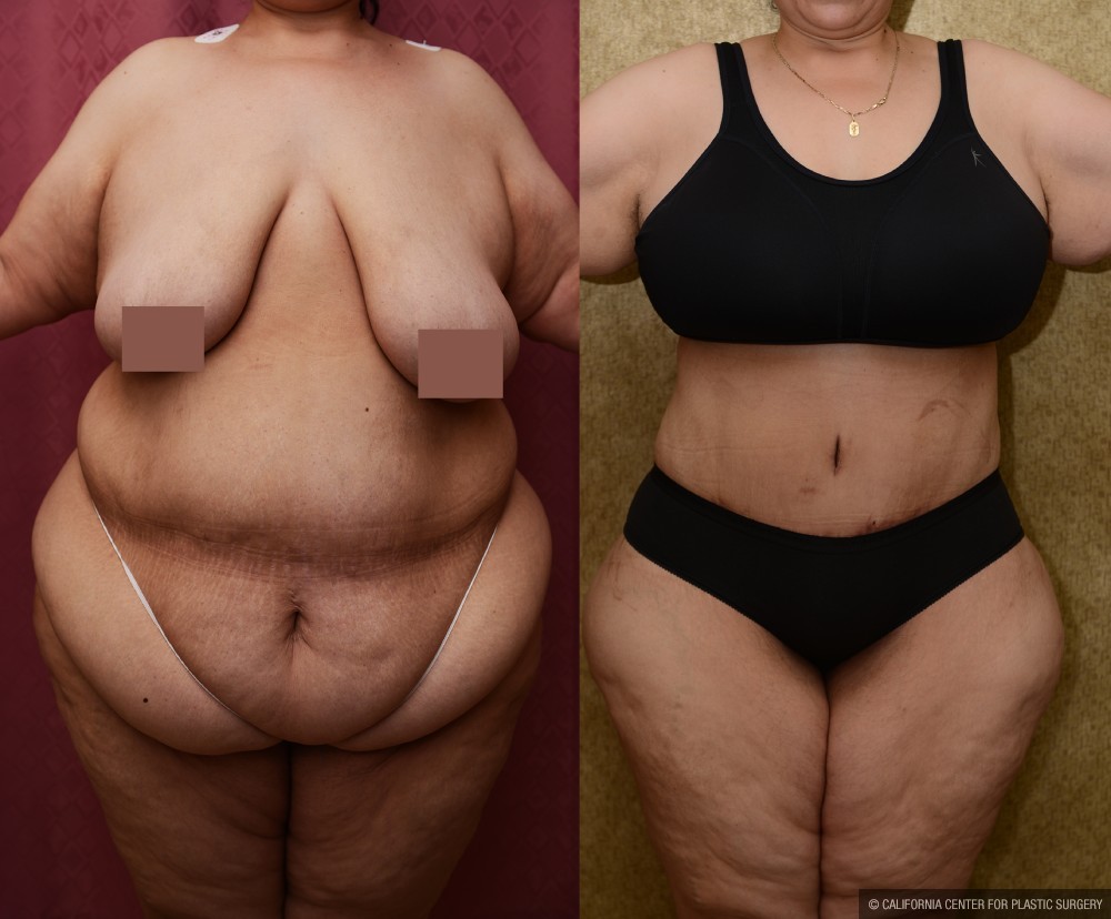 Tummy Tuck (Abdominoplasty) Super Plus Size Before & After Patient #13655