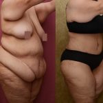Tummy Tuck (Abdominoplasty) Super Plus Size Before & After Patient #13655