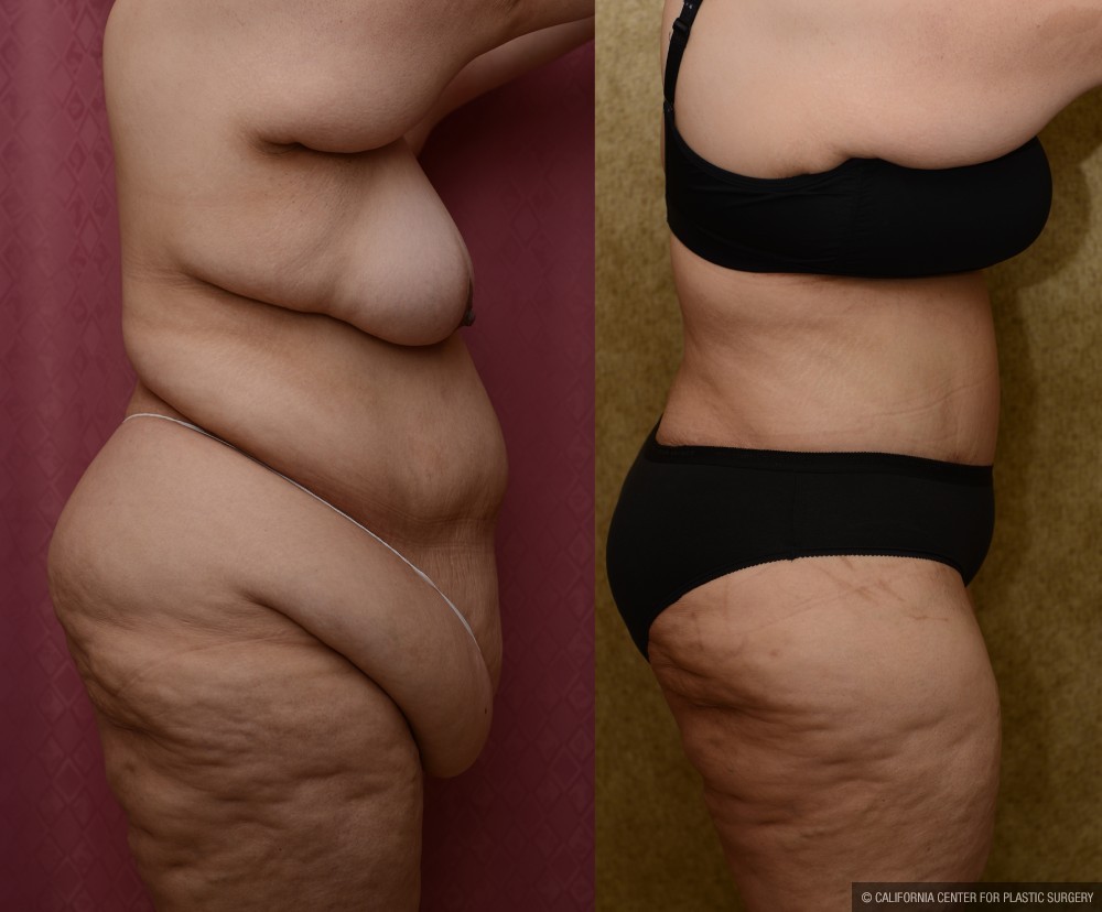 Tummy Tuck (Abdominoplasty) Super Plus Size Before & After Patient #13655
