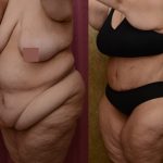 Tummy Tuck (Abdominoplasty) Super Plus Size Before & After Patient #13655