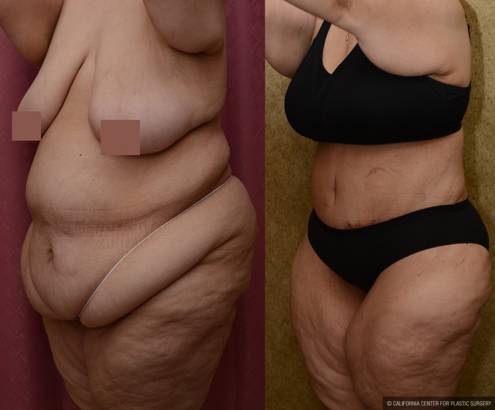 Tummy Tuck (Abdominoplasty) Super Plus Size Before & After Patient #13655