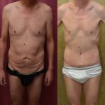 Male Tummy Tuck (abdominoplasty) Before & After Patient #13574